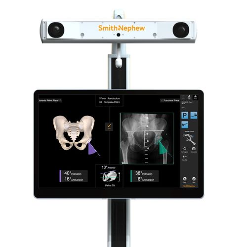 髋部假体定位手术导航系统 - RI - Smith & Nephew - 光学
