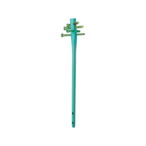 肱骨髓内钉 - TRIGEN™ - Smith & Nephew/美国施乐辉 - 近端固定 / 远端固定 / 金属