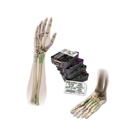 手加压接骨板 - VLP™ MINI-MOD™ - Smith & Nephew/美国施乐辉 - 跖趾关节 / 手腕 / 脚踝
