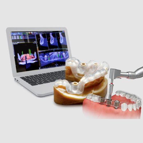 导向外科手术软件 - Implant3D - B&B DENTAL - 分析 / 3D 可视化 / 口腔移植手术