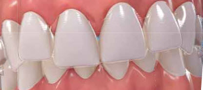 牙科矫正器 - Invisalign - Align Technology
