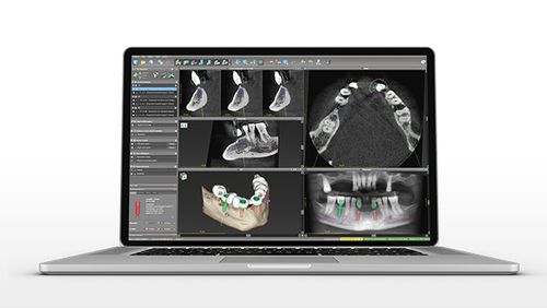 医学规划软件 - coDiagnostiX - Dental Wings   - 设计 / 牙科手术 / 牙科