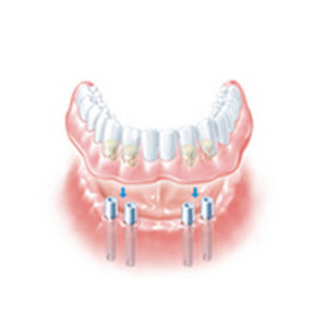 金属种植体基台 - ANKYLOS® SynCone® - DENTSPLY Implants GmbH - 直线型