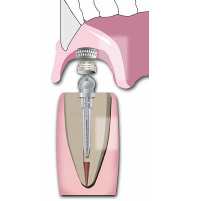 金属牙根管桩 - Flexi-Overdenture - ESSENTIAL DENTAL SYSTEMS  