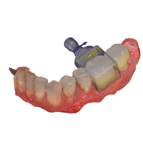 设计软件模块 - In-CAD Nesting - exocad GmbH   - CAD / 打印机 / 生产