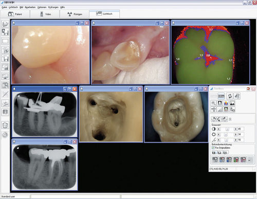 医疗可视化软件 - DBSWIN  - Dürr Dental - 诊断 / 规划 / 设计