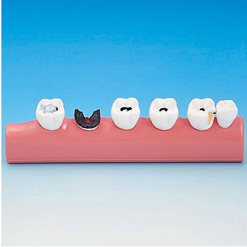 牙科解剖模型 - PE-TDS005 - Nissin Dental Products Inc.   - 教学 / 龋齿
