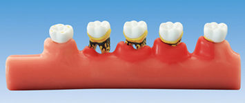 牙科解剖模型 - PE-PER010 - Nissin Dental Products Inc.   - 肋骨 / 用于牙周 / 教学