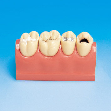 牙科解剖模型 - PE-STP007 - Nissin Dental Products Inc.   - 教学 / 龋齿