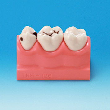 牙科解剖模型 - PE-STP008 - Nissin Dental Products Inc.   - 教学 / 龋齿