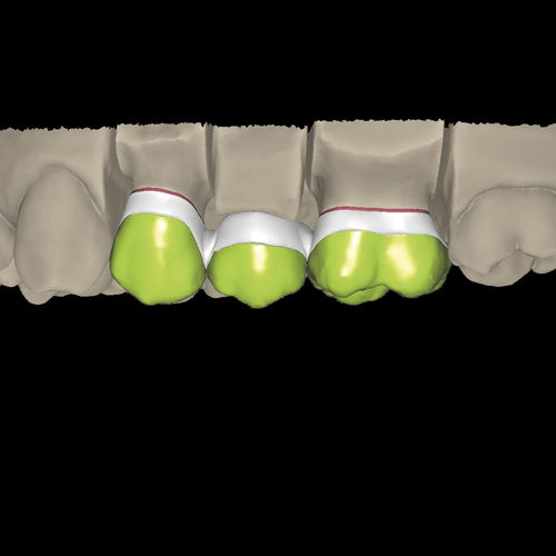 牙科实验室软件模块 - Overpress crowns and overpress bridges - Zirkonzahn - CAD / 牙修复体设计 / CAM