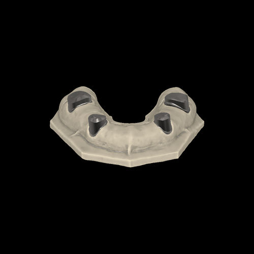 牙科实验室软件模块 - Telescopic crowns - Zirkonzahn/泽康赞 - CAD / 牙修复体设计 / CAM
