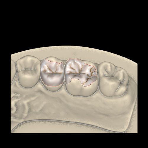牙科实验室软件模块 - Inlays/Onlays/Veneers - Zirkonzahn/泽康赞 - 牙修复体设计 / CAM / CAD
