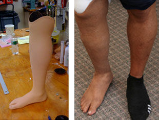腿部整形假体 - Boston Orthotics + Prosthetics - 成人