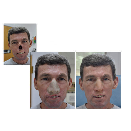 鼻部整形假体 - RealLifeSkin™ - RealLifeSkin - 成人