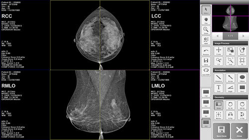 乳腺X射线造影软件 - BRESTATION LITE - MEDI-FUTURE - 图像分析 / 管理 / 诊断