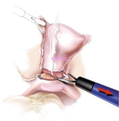腹腔镜电极 - LapLoop  - OPTEC Endoscopy Systems - 环形 / 单极