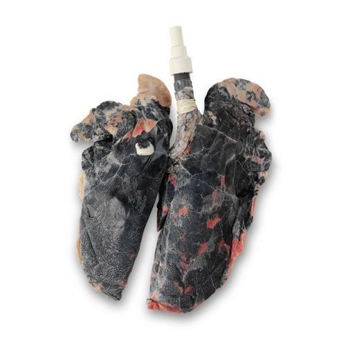 肺部解剖模型 - LS03766 - Nasco - 吸烟影响