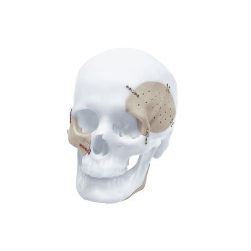 定制颅内植入物 - TRUMATCH™ - Depuy Synthes/德普