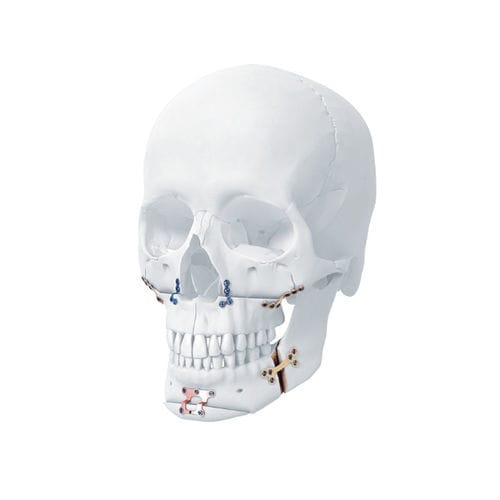 下颚加压接骨板 - MatrixORTHOGNATHIC™ - Depuy Synthes/德普 - 颌骨 / 锁定 / 金属