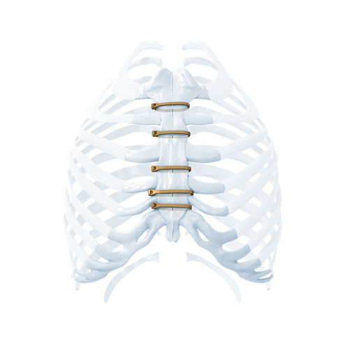胸腔闭合骨科环扎线 - ZIPFIX™ - Depuy Synthes/德普 - 金属单丝