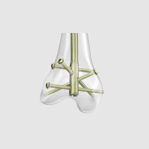 股骨髓内钉 - RFN-ADVANCED™ - Depuy Synthes/德普 - 远端固定 / 金属