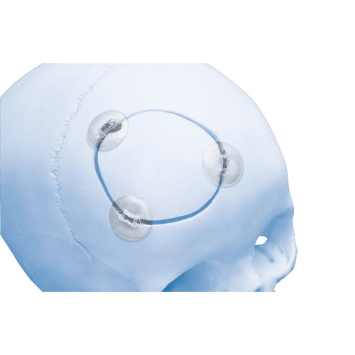 可吸收颅骨固定系统 - RAPIDSORB™  - Depuy Synthes/德普
