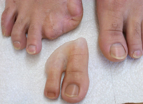 脚趾整形假体 - Aesthetic Prosthetics - 成人