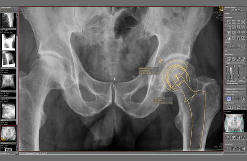规划软件模块 - dicomPACS® Prosthesis  - OR Technology - Oehm und Rehbein - 医学成像 / 用于骨科手术