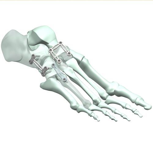 跗跖关节关节固定板 - HJ-Expandable 01 - Health-Joy Medical - 侧面 / 远侧 / 背部