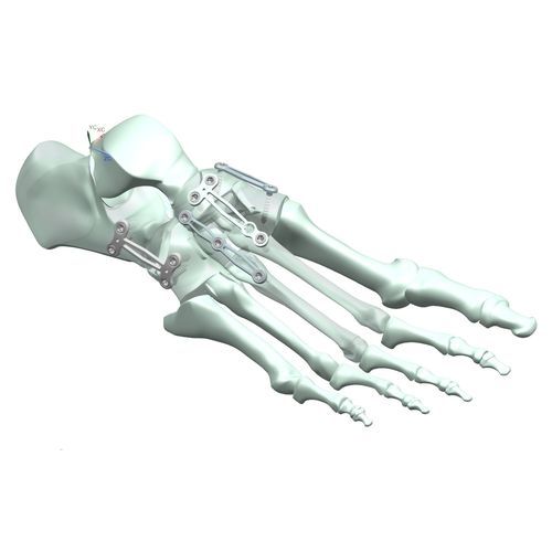 跖趾关节关节固定板 - HJ-Expandable 02 - Health-Joy Medical - 跗跖关节 / 距关节 / 跖骨