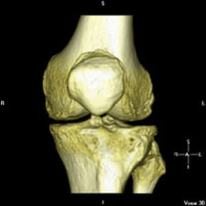 膝盖假体设计软件 - iFit® - ConforMIS - 解剖学 / 用于骨科手术