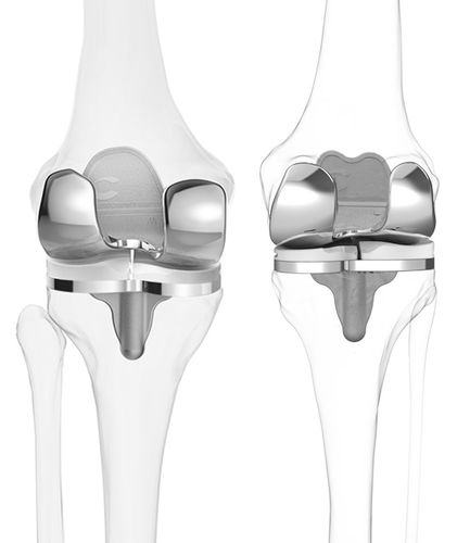 三间隔膝关节假体 - iTotal® CR - ConforMIS - 滑动，带十字韧带 / 骨水泥固定