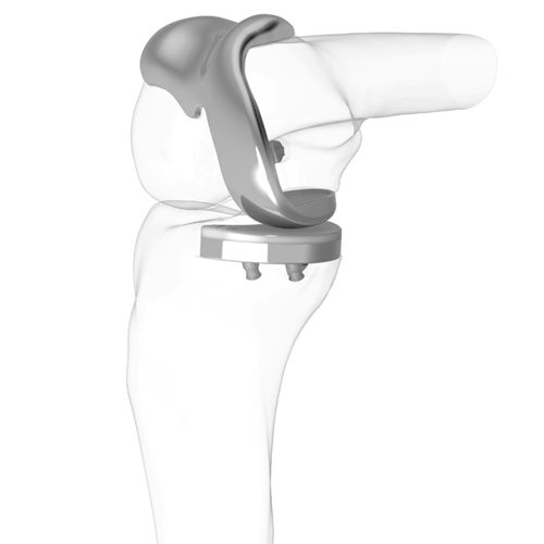单间隔膝关节假体 - iDuo®  - ConforMIS - 固定轴承 / 骨水泥固定