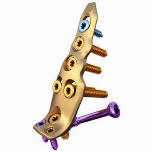 腓骨加压接骨板 - ORTHOLOC™ - Wright Medical Technology - 远侧 / 锁定 / 未锁定