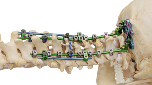 枕颈胸脊柱内固定系统 - Invictus® OCT - Alphatec Spine - 后入路