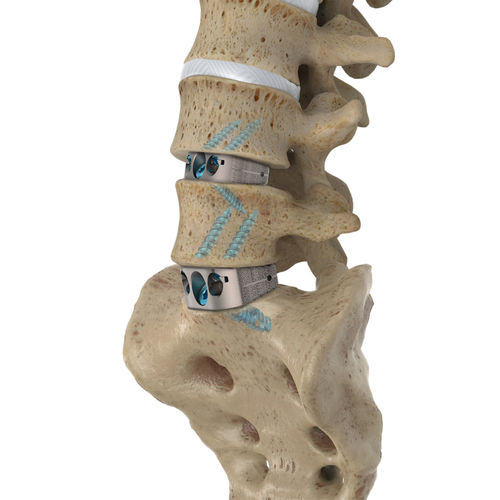 腰骶椎间融合器 - IdentiTi™ ALIF Standalone - Alphatec Spine - 前入路 / 钛