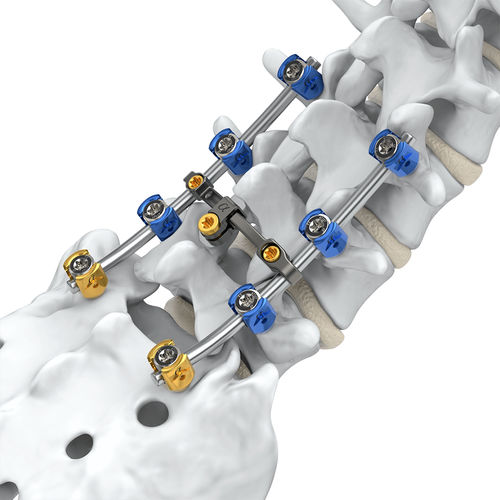 腰骶脊柱内固定系统 - Arsenal™  - Alphatec Spine - 后入路