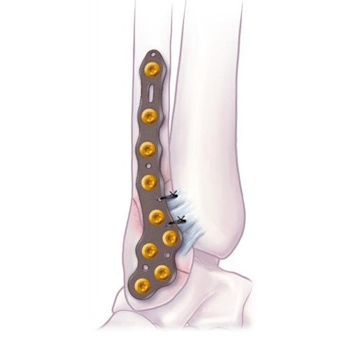 腓骨加压接骨板 - VOLITION™  - Ortho Solutions - 踝部 / 远侧 / 侧面
