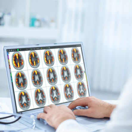 颅内成像软件 - MIMneuro® - MIM Software - 分析 / 3D 可视化 / 诊断