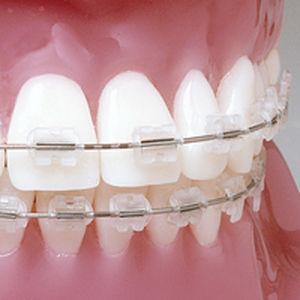 美容整形下颌正畸托架 - Prism™ - G&H Orthodontics - 透明