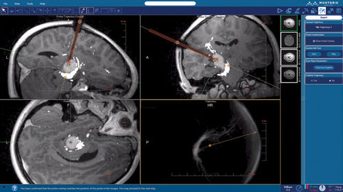 医学规划软件 - NeuroBlate ® SoftwareTM NeuroBlate ® - Monteris Medical - 采集 / 用于扫描身体轮廓 / 医学成像