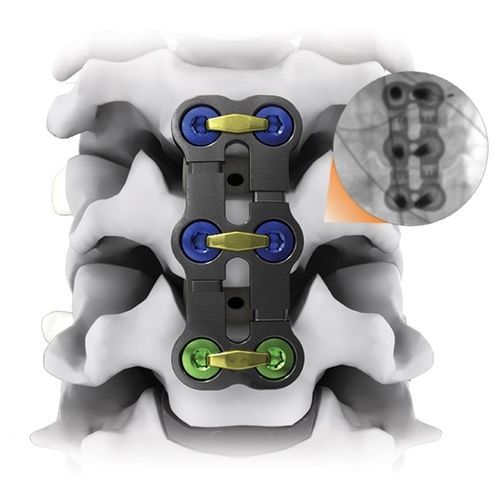 颈椎关节固定板 - KINETIC® - Life Spine - 锁定 / 金属 / 2节