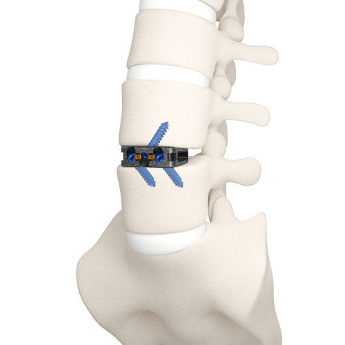 腰椎间融合器 - DYNA-LINK® - Life Spine - 前入路 / 钛