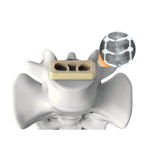 腰椎间融合器 - PLATEAU®-X - Life Spine - 侧方入路 / PEEK材质