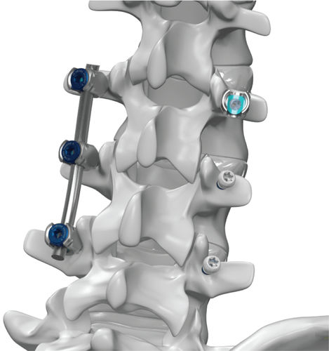 胸腰椎脊柱内固定系统 - ARx® - Life Spine - 后入路