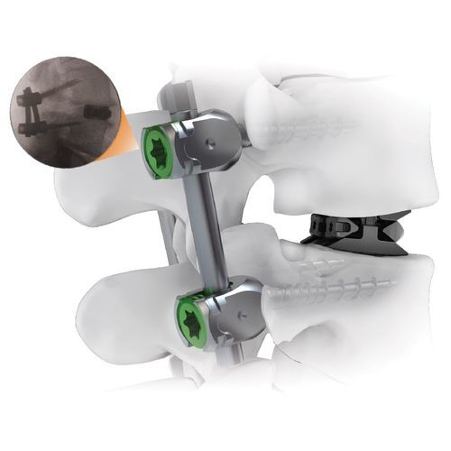 胸腰椎脊柱内固定系统 - CENTERLINE® - Life Spine - 后入路