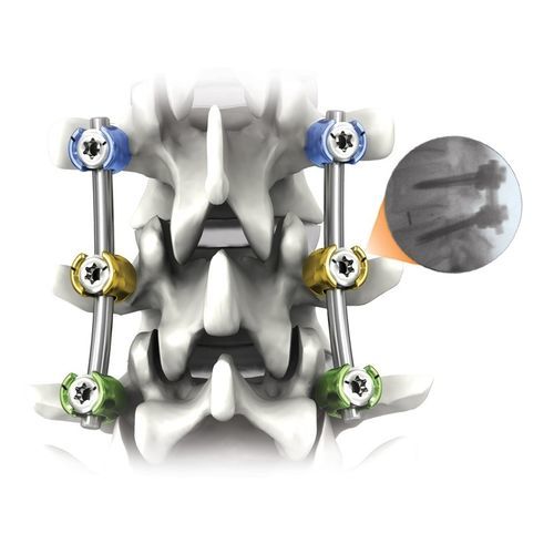 胸腰椎脊柱内固定系统 - NAUTILUS® - Life Spine - 后入路