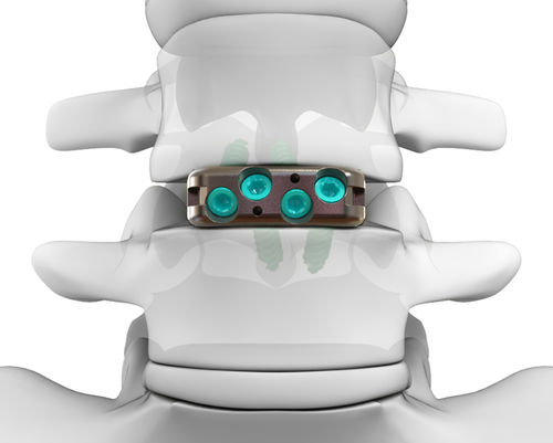 腰椎间融合器 - DYNA-LINK® ELITE - Life Spine - 前入路