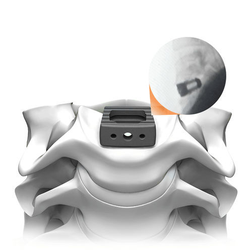 颈椎间融合器 - PLATEAU®-C Ti - Life Spine - 前入路 / 钛